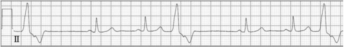 這種室早，不懷好意，應(yīng)該警惕！