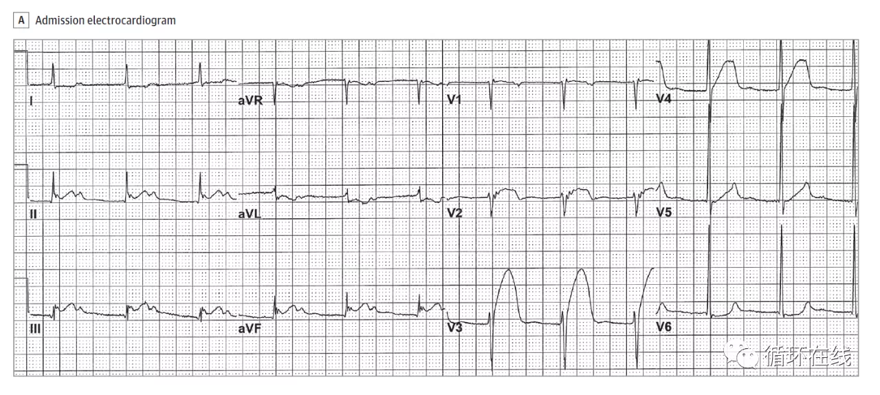 ST段廣泛抬高的急性心肌梗死，罪犯血管在哪里？