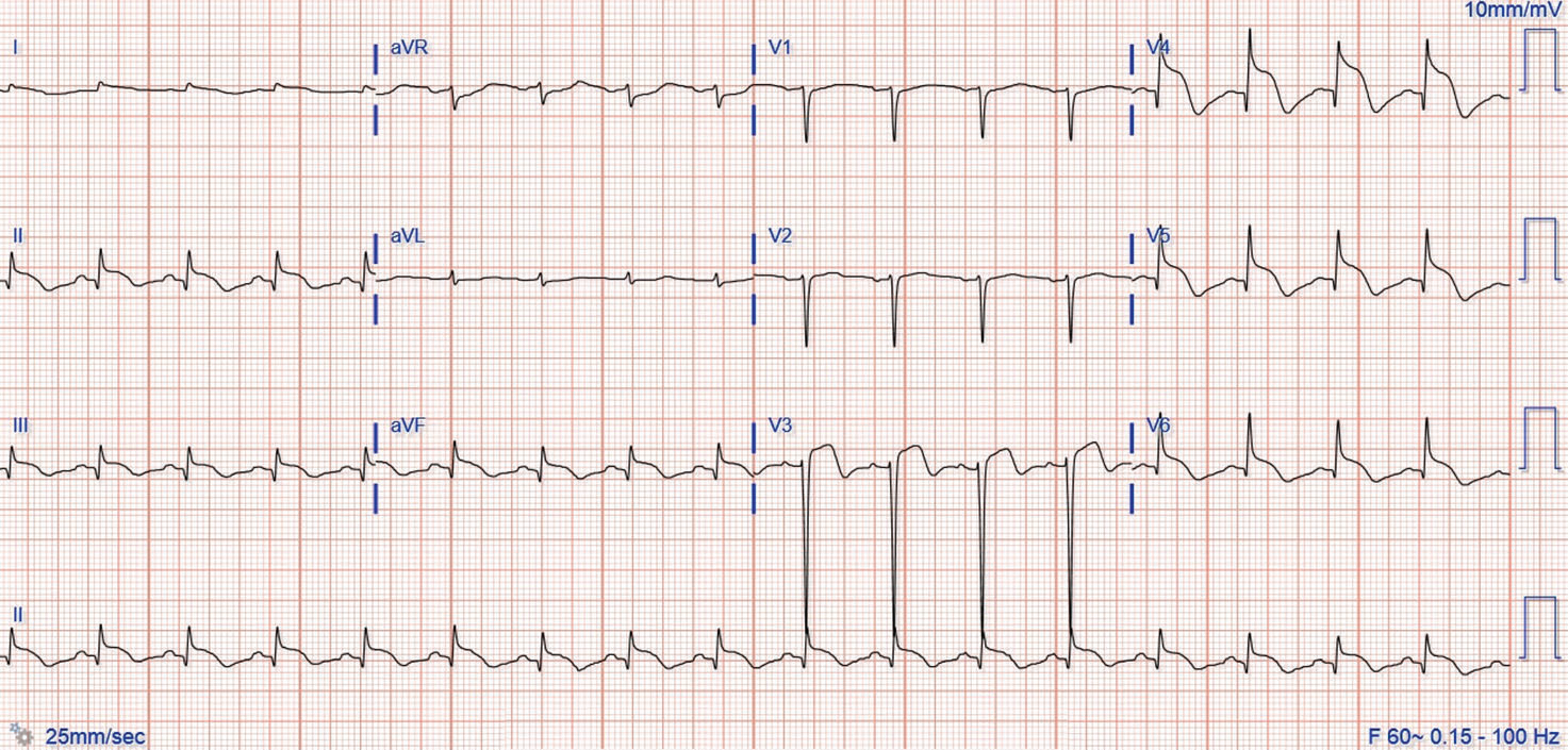 挑戰心電圖：這種特殊的ST段抬高，你認識嗎？
