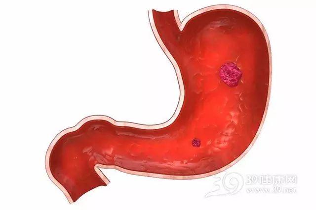 這種胃痛，是胃癌來臨的預(yù)報(bào)！