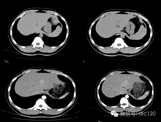 肝局灶性結節增生（FNH）