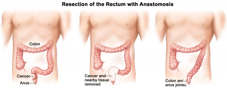 直腸癌怎么治療？如何在“保命”的基礎上實現“保肛”？