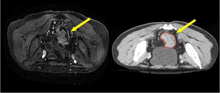 直腸癌的三維放療及調強放療靶區勾畫