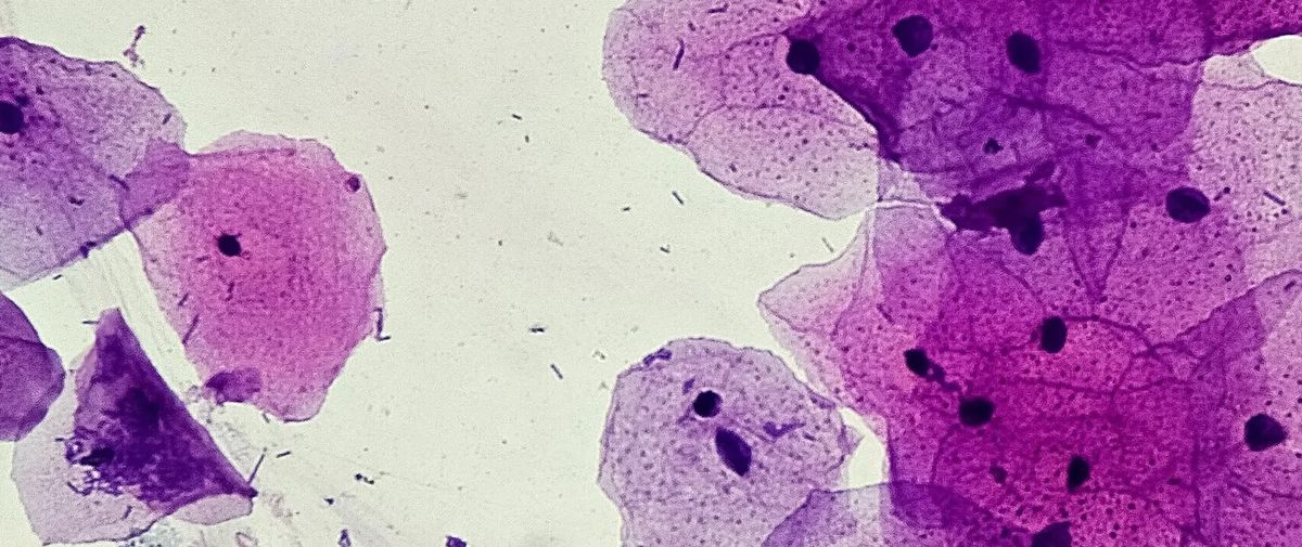 Cancerous oral squamous cells