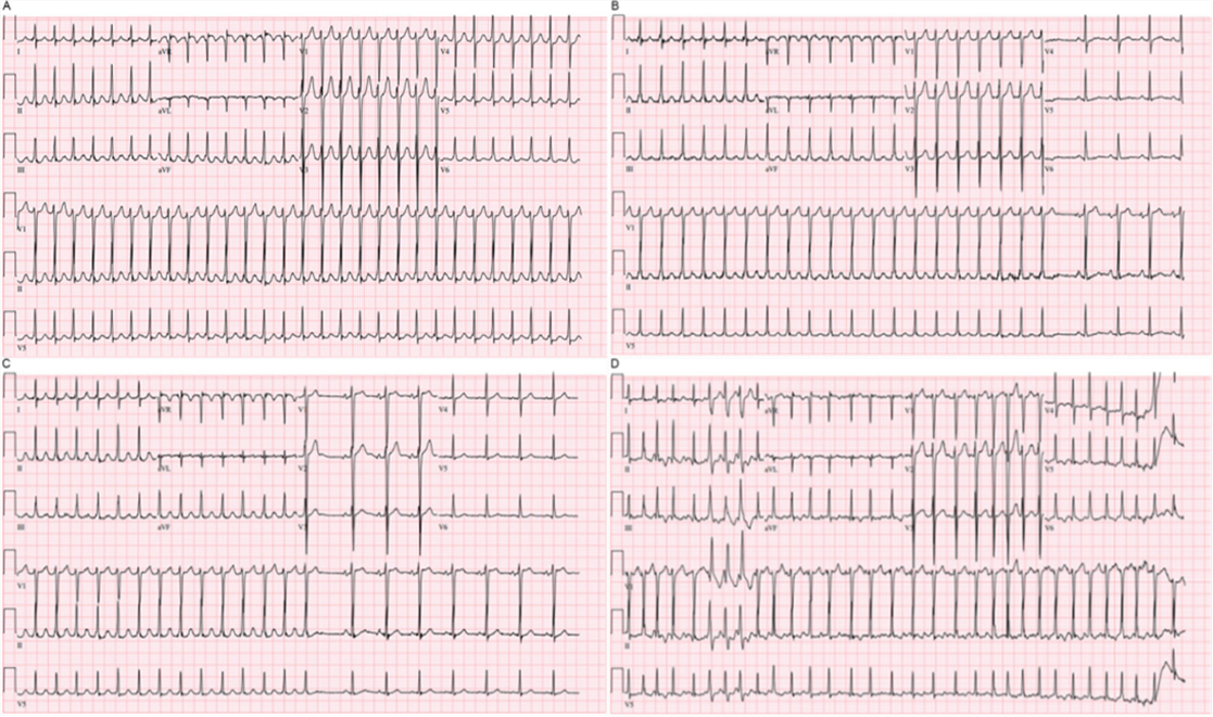 陽康后心血管后遺癥不只是心肌炎，心律失常的危害同樣不容小覷