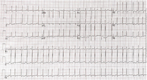 翻譯-Dysrhythmias associated with COVID14788.png