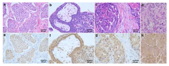 BJC：首個抗癌制劑PAC-1在人類癌癥臨床試驗中展現出巨大希望