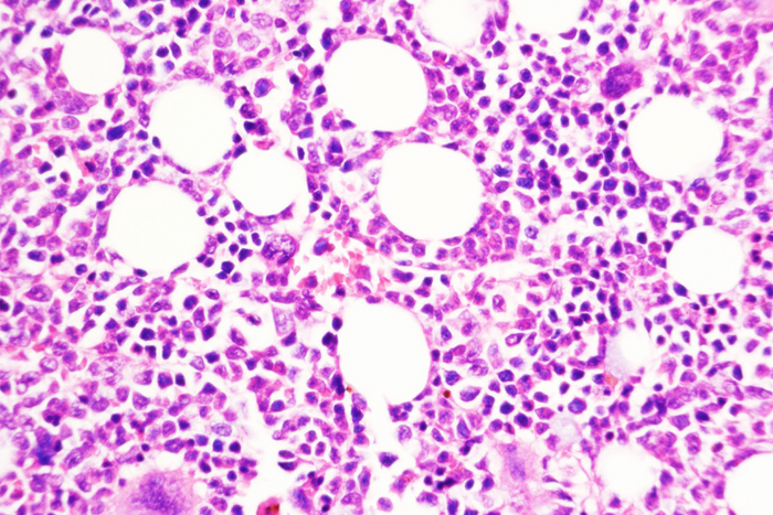 Nature Cancer揭示了慢性血癌如何轉變為侵襲性疾病